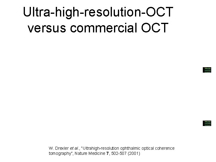 Ultra-high-resolution-OCT versus commercial OCT W. Drexler et al. , “Ultrahigh-resolution ophthalmic optical coherence tomography”,