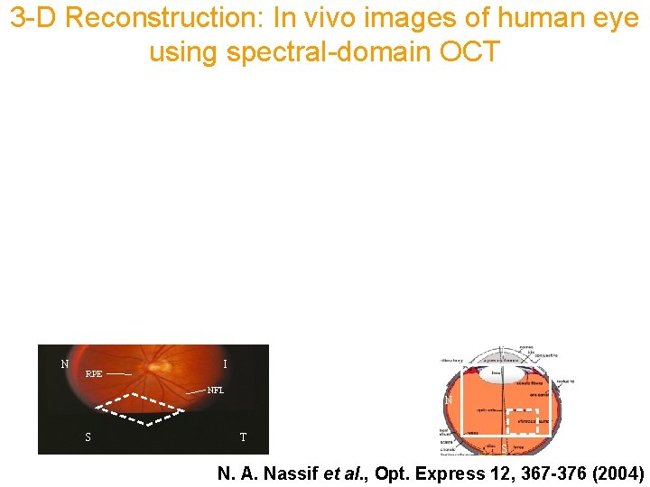 3 -D Reconstruction: In vivo images of human eye using spectral-domain OCT I N