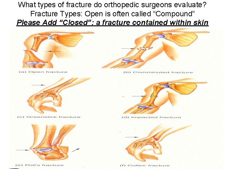 What types of fracture do orthopedic surgeons evaluate? Fracture Types: Open is often called