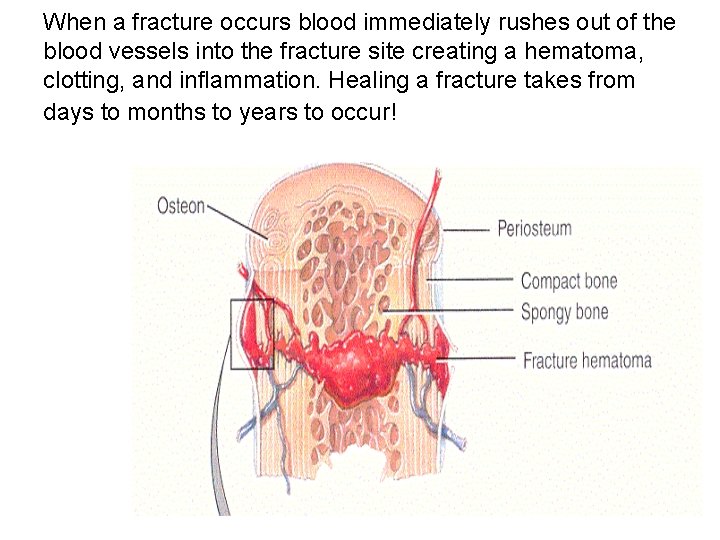 When a fracture occurs blood immediately rushes out of the blood vessels into the