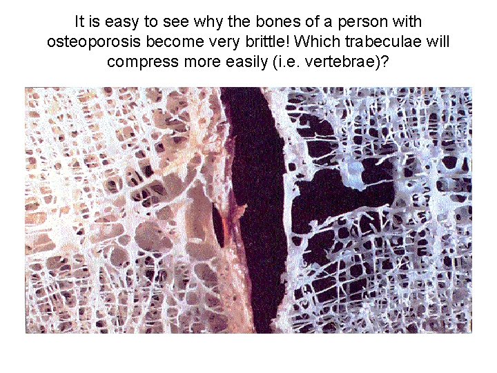 It is easy to see why the bones of a person with osteoporosis become