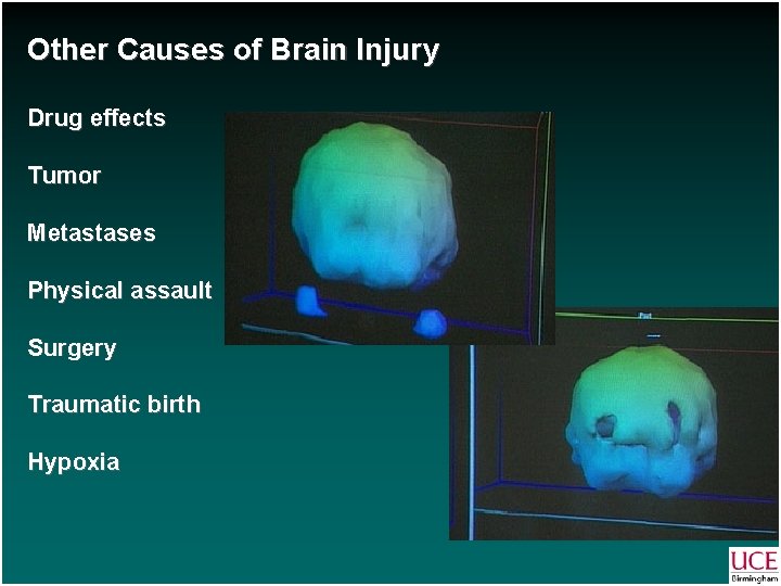 Other Causes of Brain Injury Drug effects Tumor Metastases Physical assault Surgery Traumatic birth