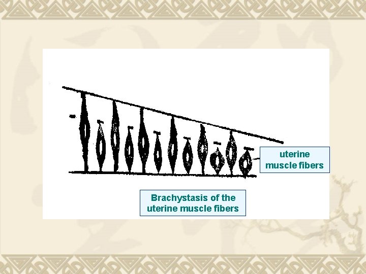 uterine muscle fibers Brachystasis of the uterine muscle fibers 