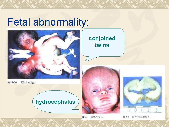 Fetal abnormality: conjoined twins hydrocephalus 