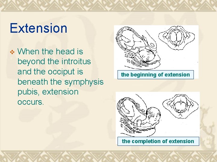 Extension v When the head is beyond the introitus and the occiput is beneath