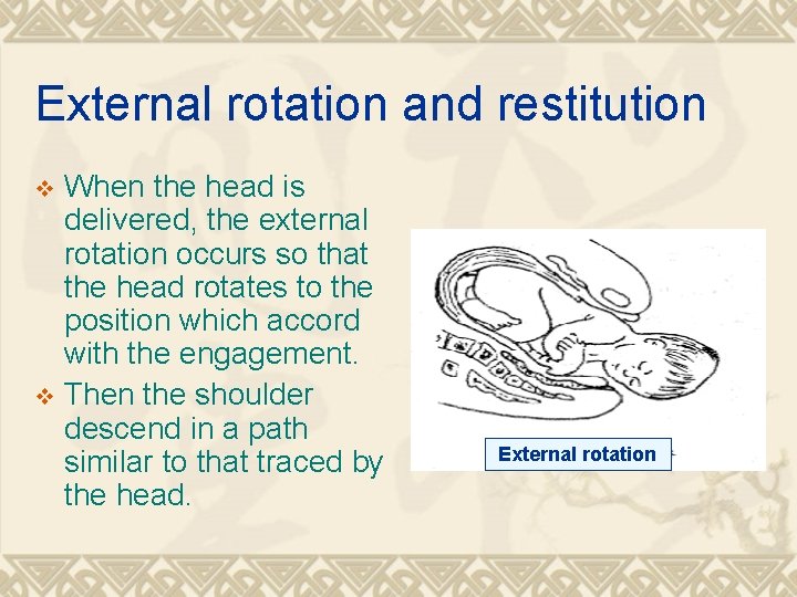 External rotation and restitution When the head is delivered, the external rotation occurs so