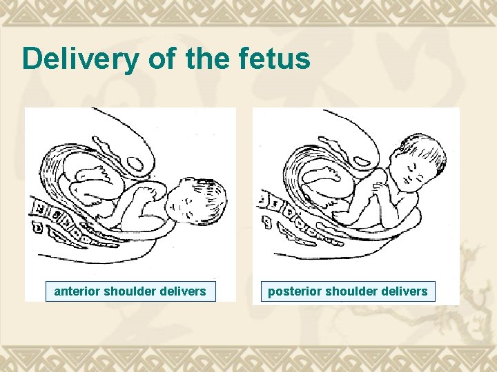 Delivery of the fetus anterior shoulder delivers posterior shoulder delivers 