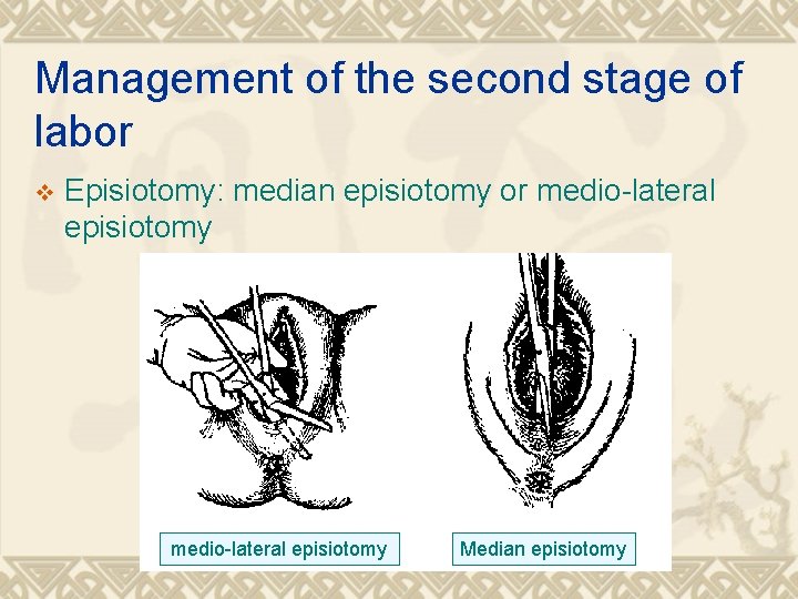 Management of the second stage of labor v Episiotomy: median episiotomy or medio-lateral episiotomy