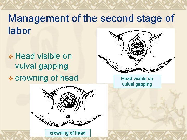 Management of the second stage of labor v Head visible on vulval gapping v