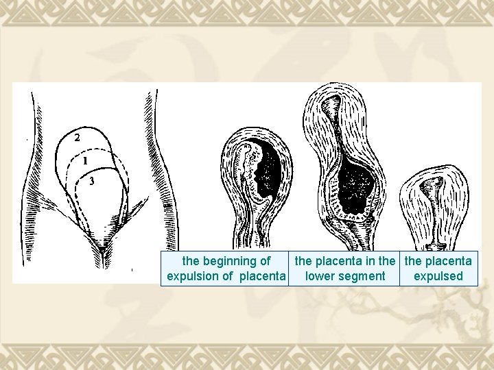 the beginning of the placenta in the placenta expulsion of placenta lower segment expulsed