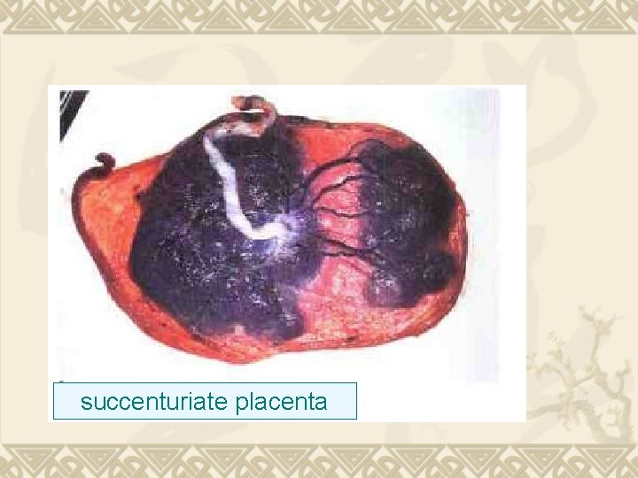 succenturiate placenta 