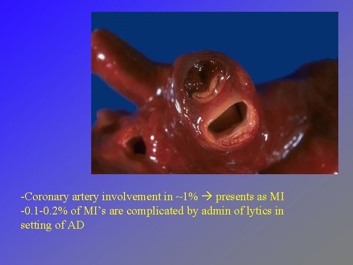 -Coronary artery involvement in ~1% presents as MI -0. 1 -0. 2% of MI’s