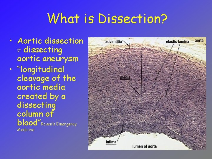 What is Dissection? • Aortic dissection dissecting aortic aneurysm • “longitudinal cleavage of the