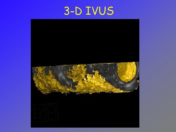 3 -D IVUS 