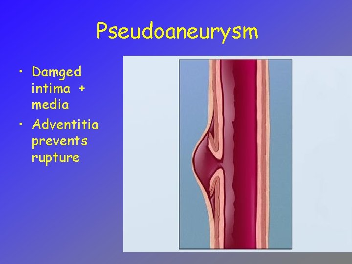 Pseudoaneurysm • Damged intima + media • Adventitia prevents rupture 