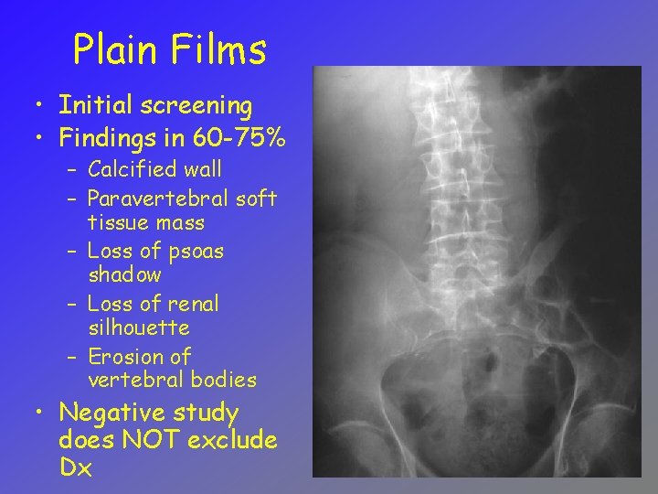 Plain Films • Initial screening • Findings in 60 -75% – Calcified wall –