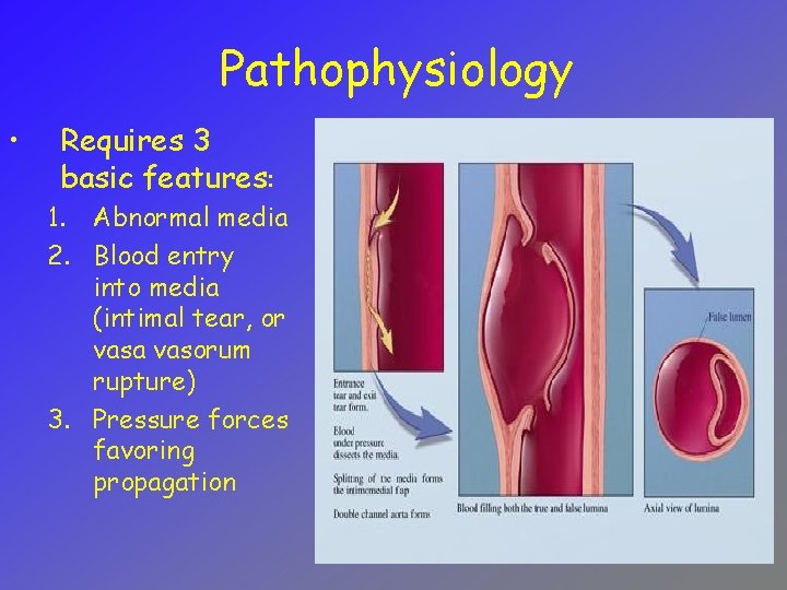 Pathophysiology • Requires 3 basic features: 1. Abnormal media 2. Blood entry into media