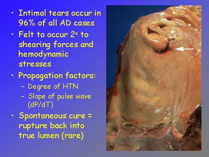 • Intimal tears occur in 96% of all AD cases • Felt to