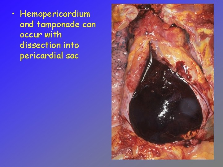  • Hemopericardium and tamponade can occur with dissection into pericardial sac 