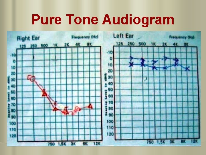 Pure Tone Audiogram 