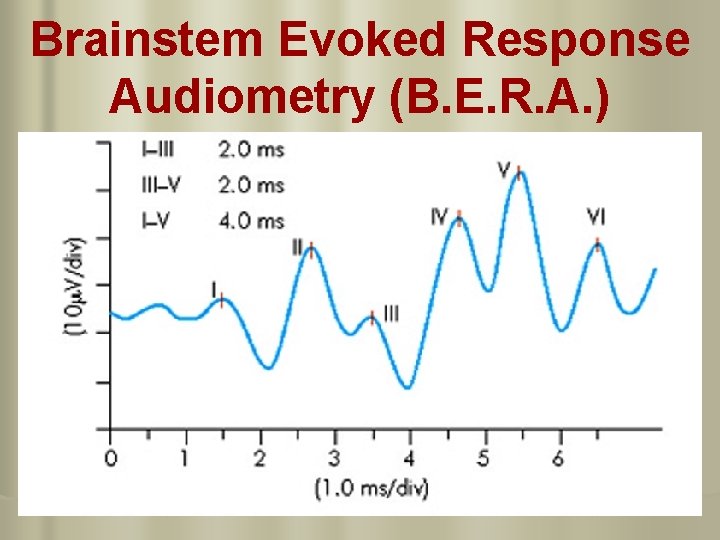 Brainstem Evoked Response Audiometry (B. E. R. A. ) 