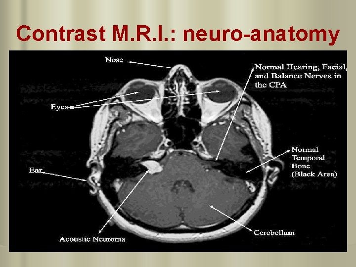 Contrast M. R. I. : neuro-anatomy 