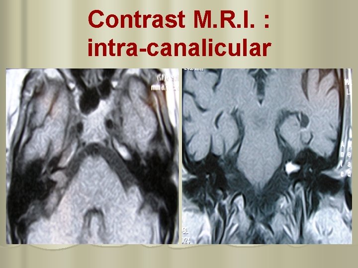 Contrast M. R. I. : intra-canalicular 