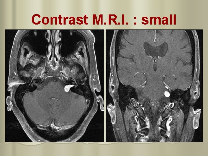 Contrast M. R. I. : small 
