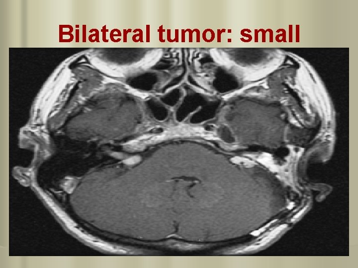 Bilateral tumor: small 