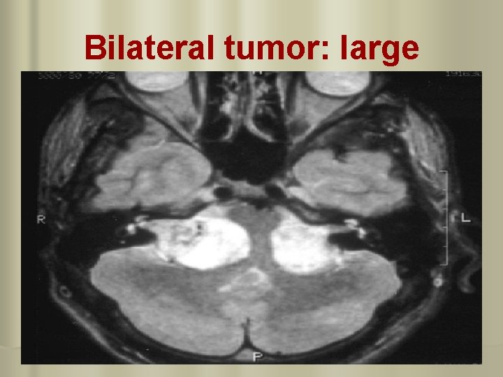 Bilateral tumor: large 