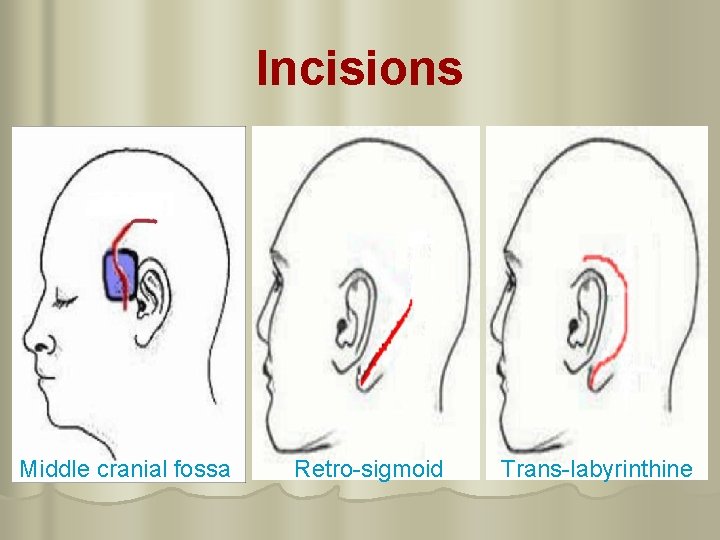 Incisions Middle cranial fossa Retro-sigmoid Trans-labyrinthine 