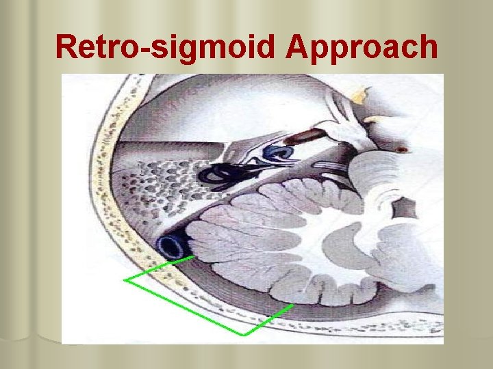 Retro-sigmoid Approach 