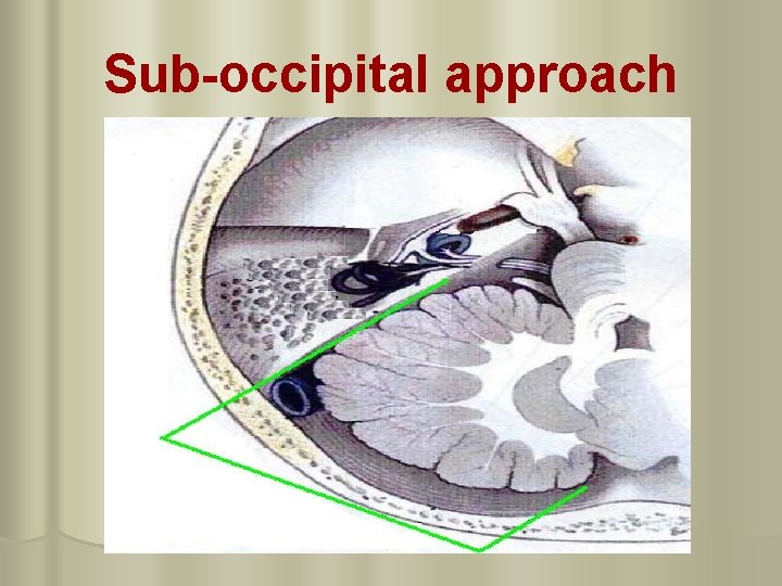 Sub-occipital approach 