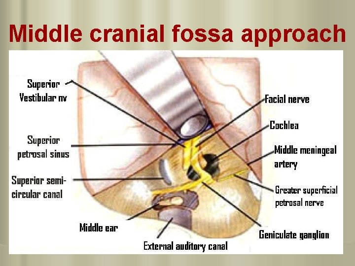 Middle cranial fossa approach 