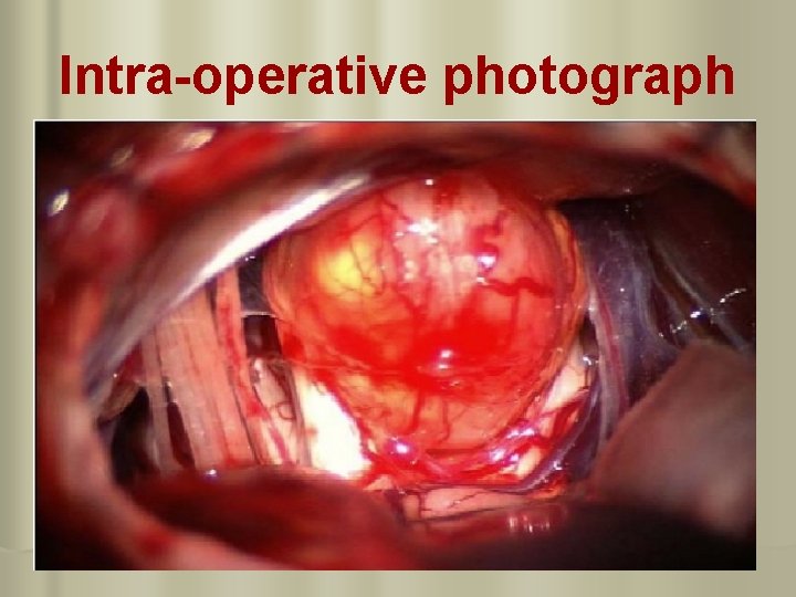 Intra-operative photograph 