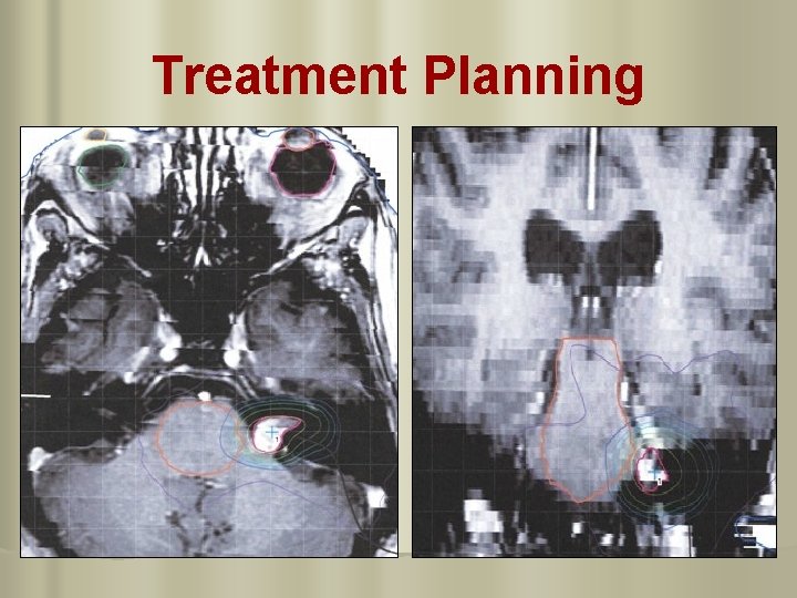 Treatment Planning 