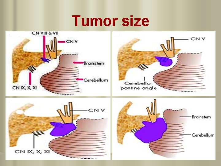 Tumor size 