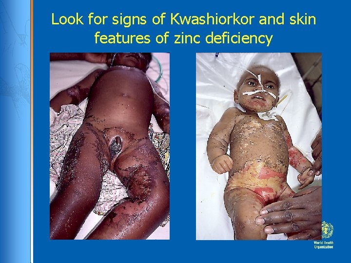 Look for signs of Kwashiorkor and skin features of zinc deficiency 