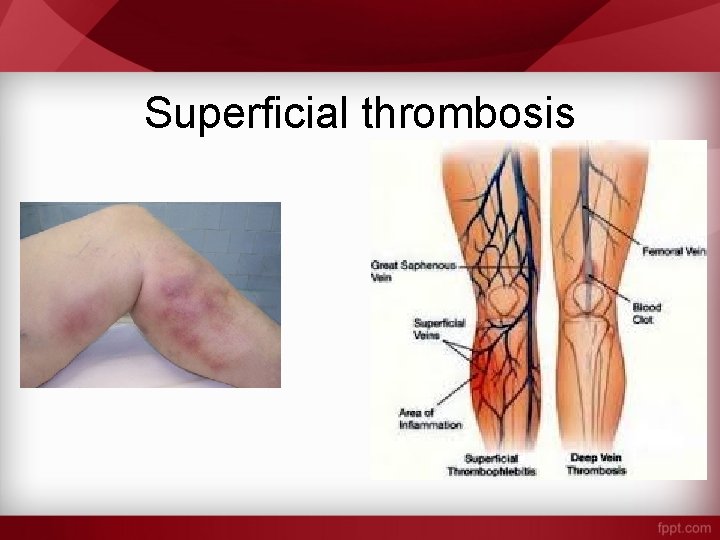 Superficial thrombosis 