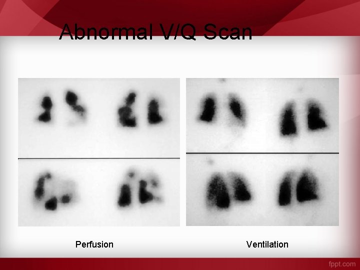 Abnormal V/Q Scan Perfusion Ventilation 