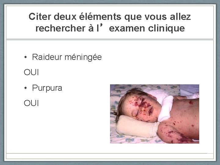 Citer deux éléments que vous allez recher à l’examen clinique • Raideur méningée OUI