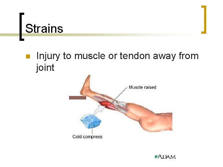 Strains n Injury to muscle or tendon away from joint 