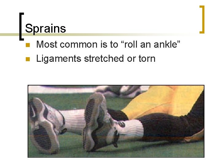 Sprains n n Most common is to “roll an ankle” Ligaments stretched or torn