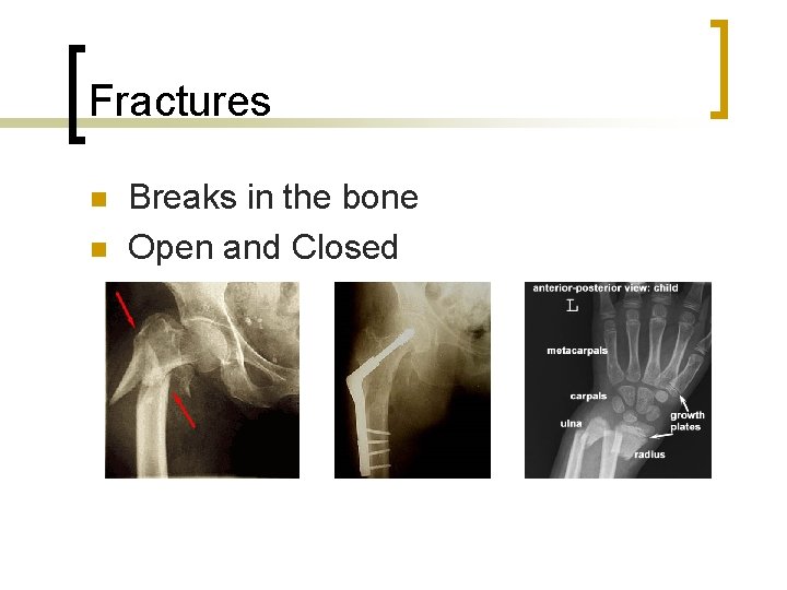 Fractures n n Breaks in the bone Open and Closed 