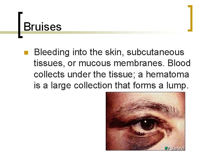Bruises n Bleeding into the skin, subcutaneous tissues, or mucous membranes. Blood collects under
