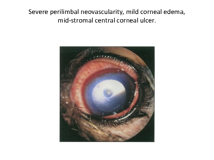 Severe perilimbal neovascularity, mild corneal edema, mid-stromal central corneal ulcer. 