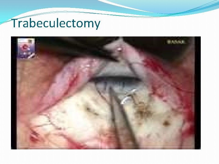 Trabeculectomy 