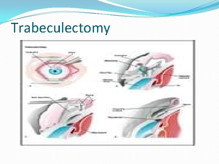 Trabeculectomy 