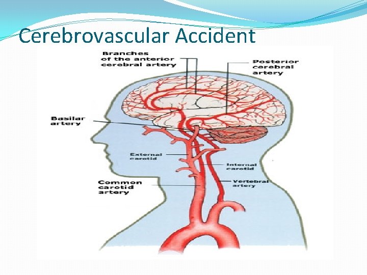 Cerebrovascular Accident 