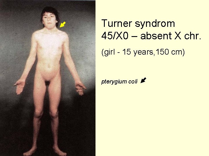Turner syndrom 45/X 0 – absent X chr. (girl - 15 years, 150 cm)